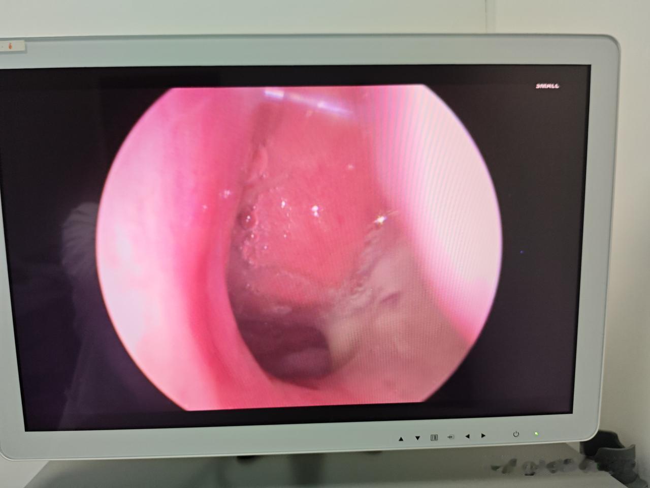 孩子腺样体肥大并非都需要手术，需结合症状严重程度、病程及对生长发育的影响，遵循专