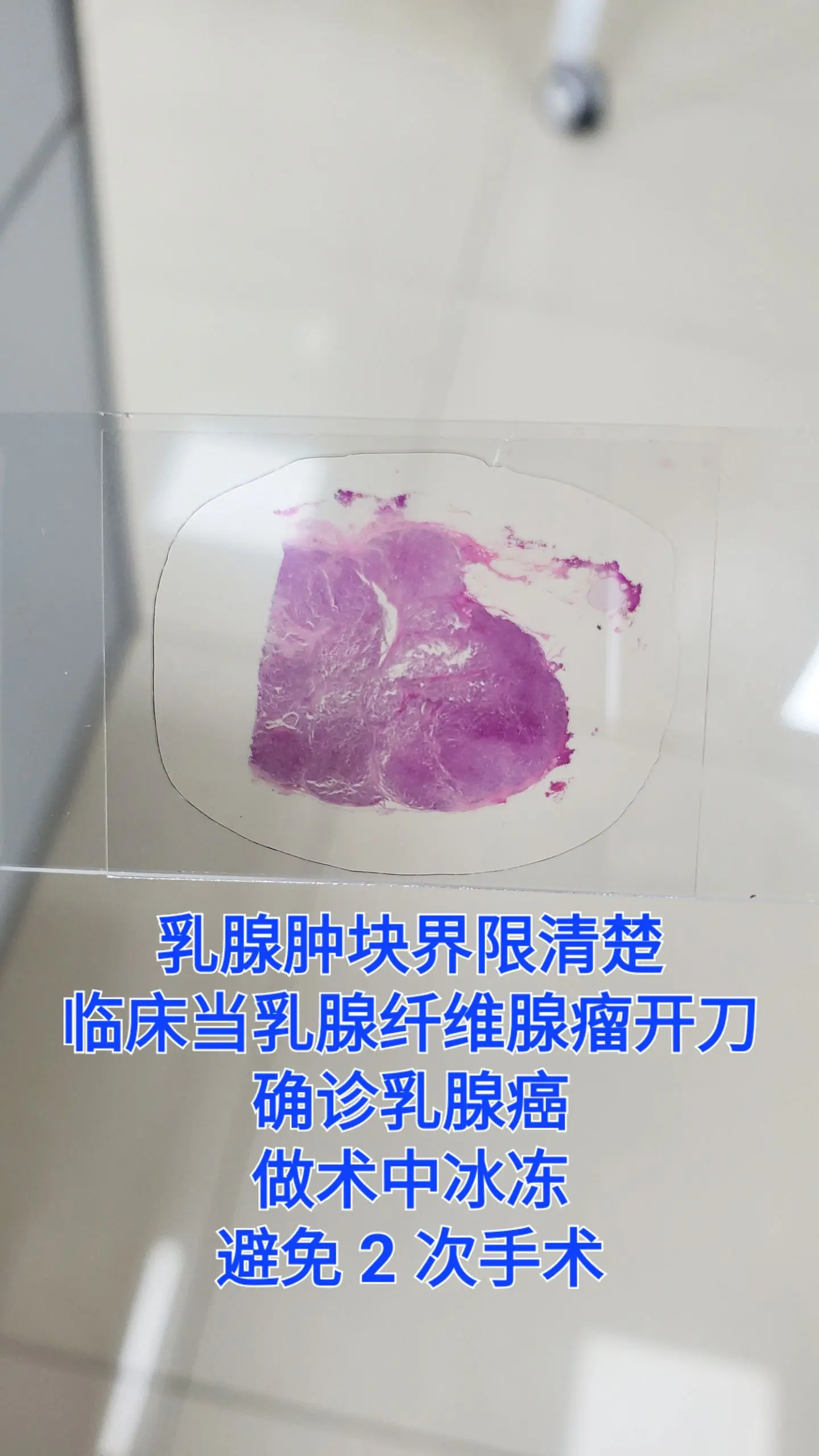 乳腺癌 术中冰冻