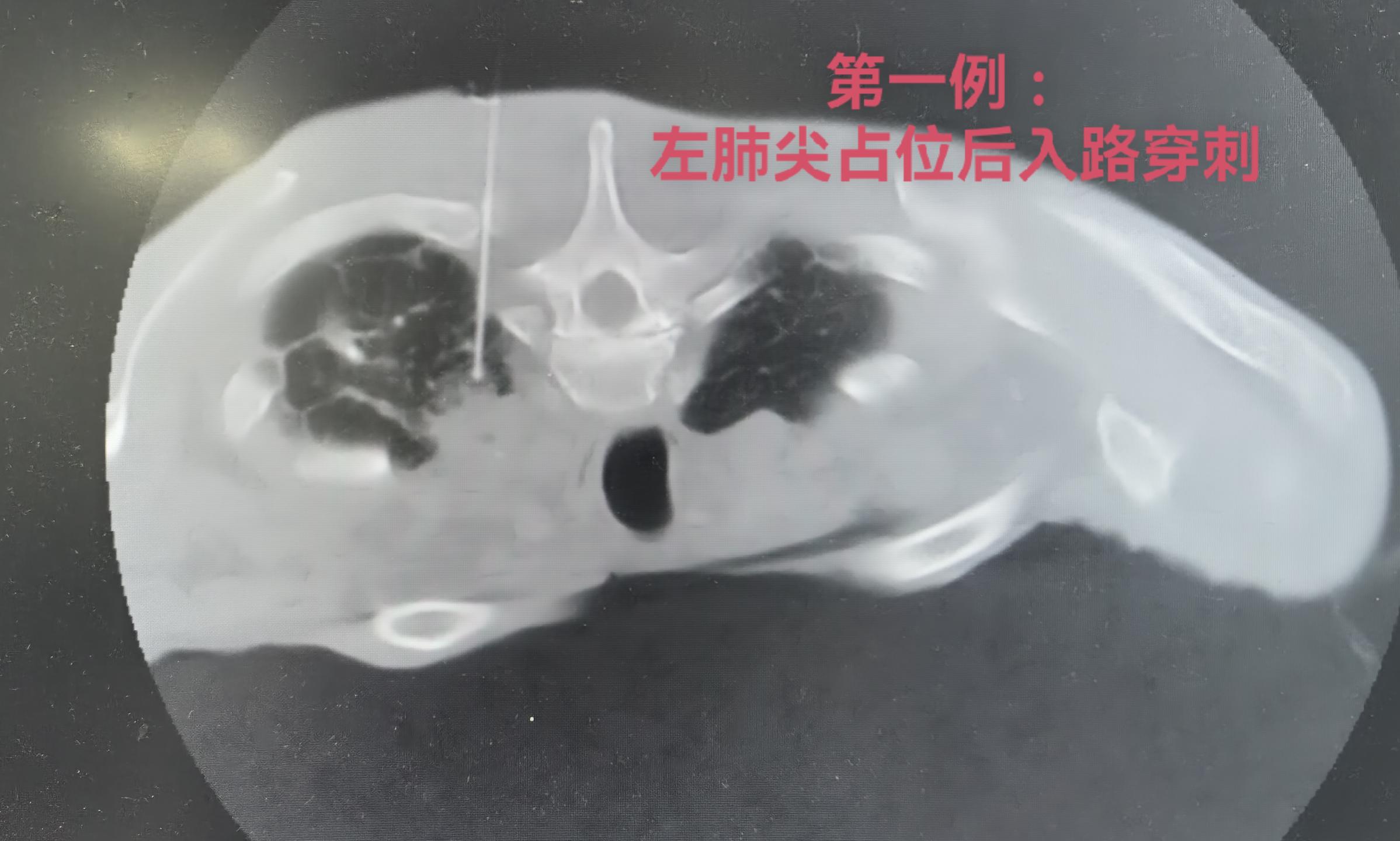 CT引导下实体肿块经皮刺活检术，精准穿刺。CT引导下实体肿块经皮刺活检...