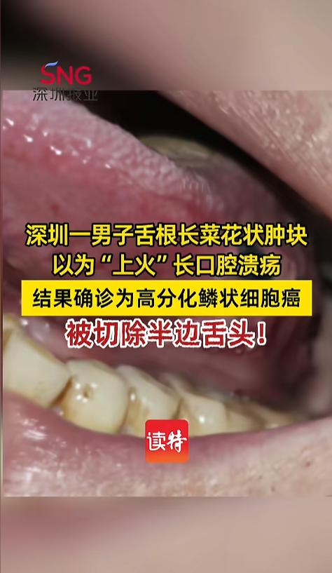 “悲剧还是发生了！”近日，广东深圳，一男子舌根上长了些菜花状的凸起，他以为是上火