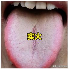 实火还是虚火，看舌苔就知道！
先看第一个实火的舌象，舌质发红，舌苔黄厚腻。

这