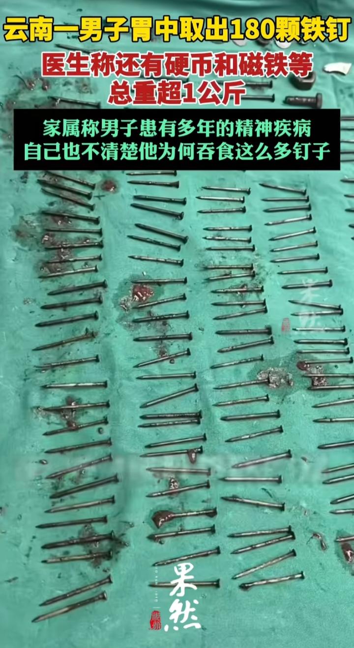 胃里取出180颗铁钉：别把异食癖当奇闻，它是藏在痛苦里的病
 
看到这则新闻，我