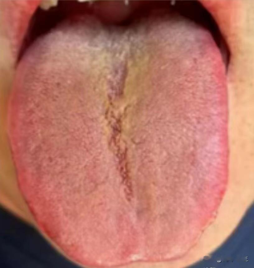 阴虚体质的人出现湿热，这么复杂的症象，只用龙胆泻肝汤可不行

今天看了这样一个舌