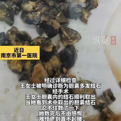 太吓人！3月3日，南京35岁女子聚餐后肚子剧痛，去医院一查，医生从她体内取出这玩