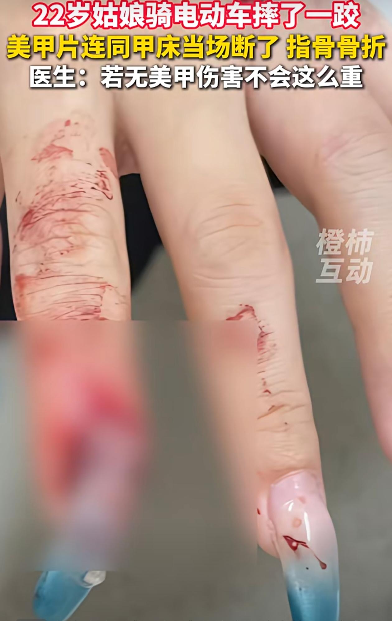 “悲剧还是发生了！”近日，浙江杭州，一女子为了让手指显得更修长，在做美甲时特意延