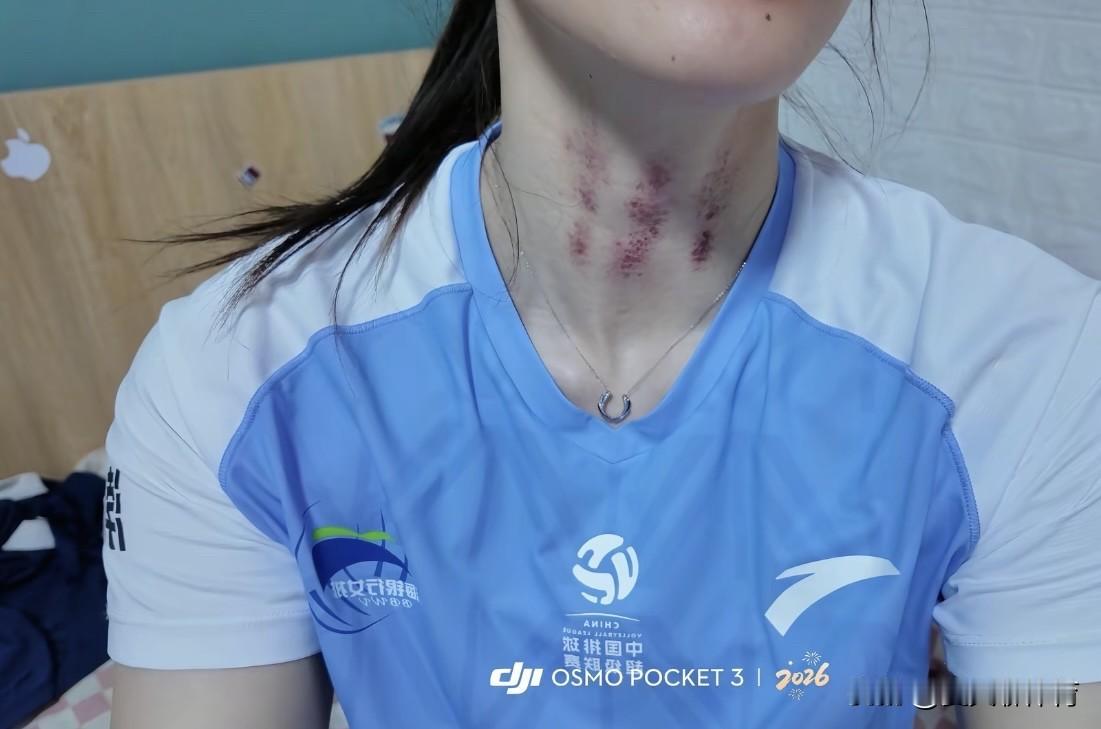 原来王艺竹用“脖子上的三条杠”，刘美君用“大腿上的
淤青块”赢的江苏女排啊。王艺