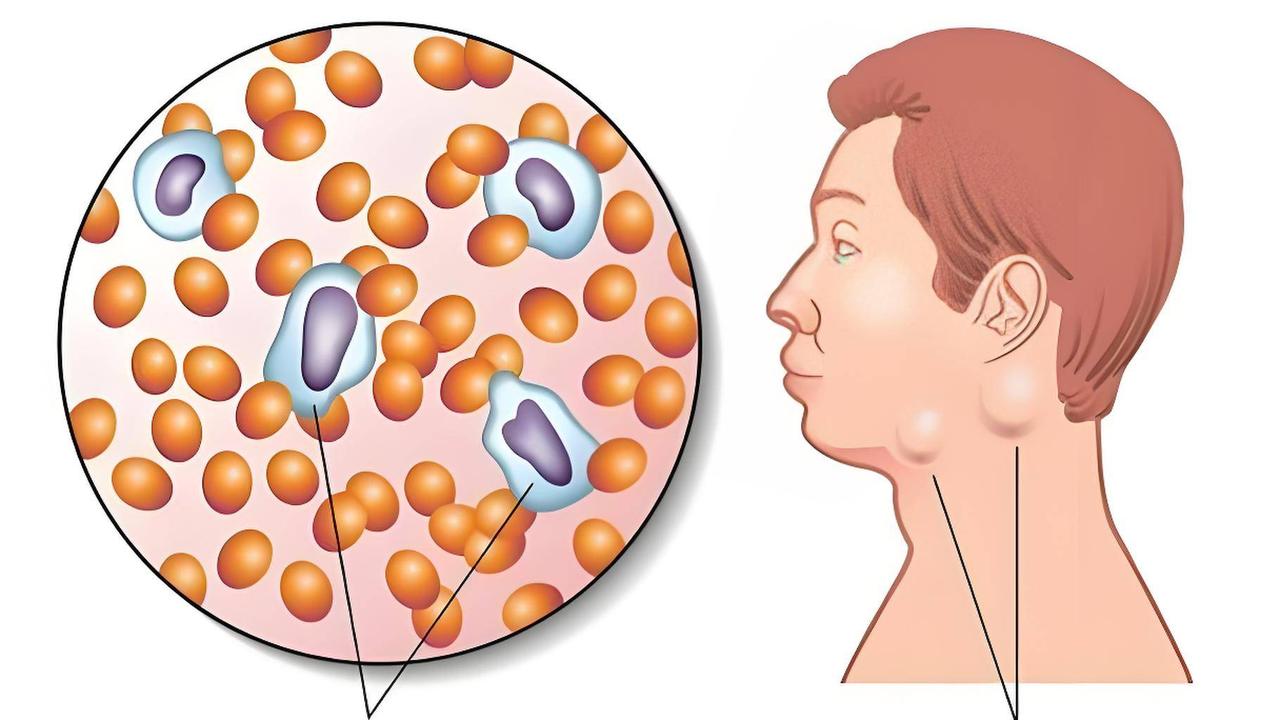 淋巴结肿大就可能是淋巴瘤吗？

淋巴结肿大最常见的原因是炎性淋巴结增生，当然也不