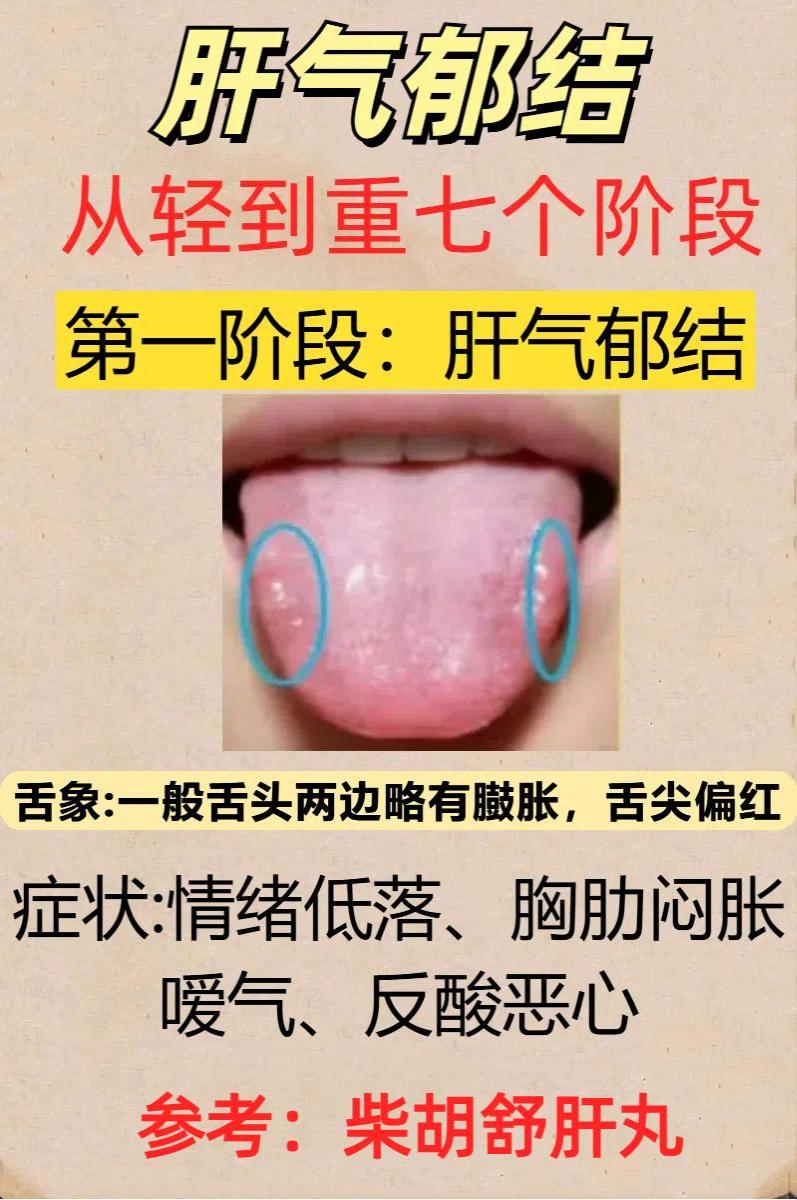 肝气郁结由轻到重7个阶段，你在哪一阶段？

第一阶段：肝气郁结——柴胡舒肝丸
第