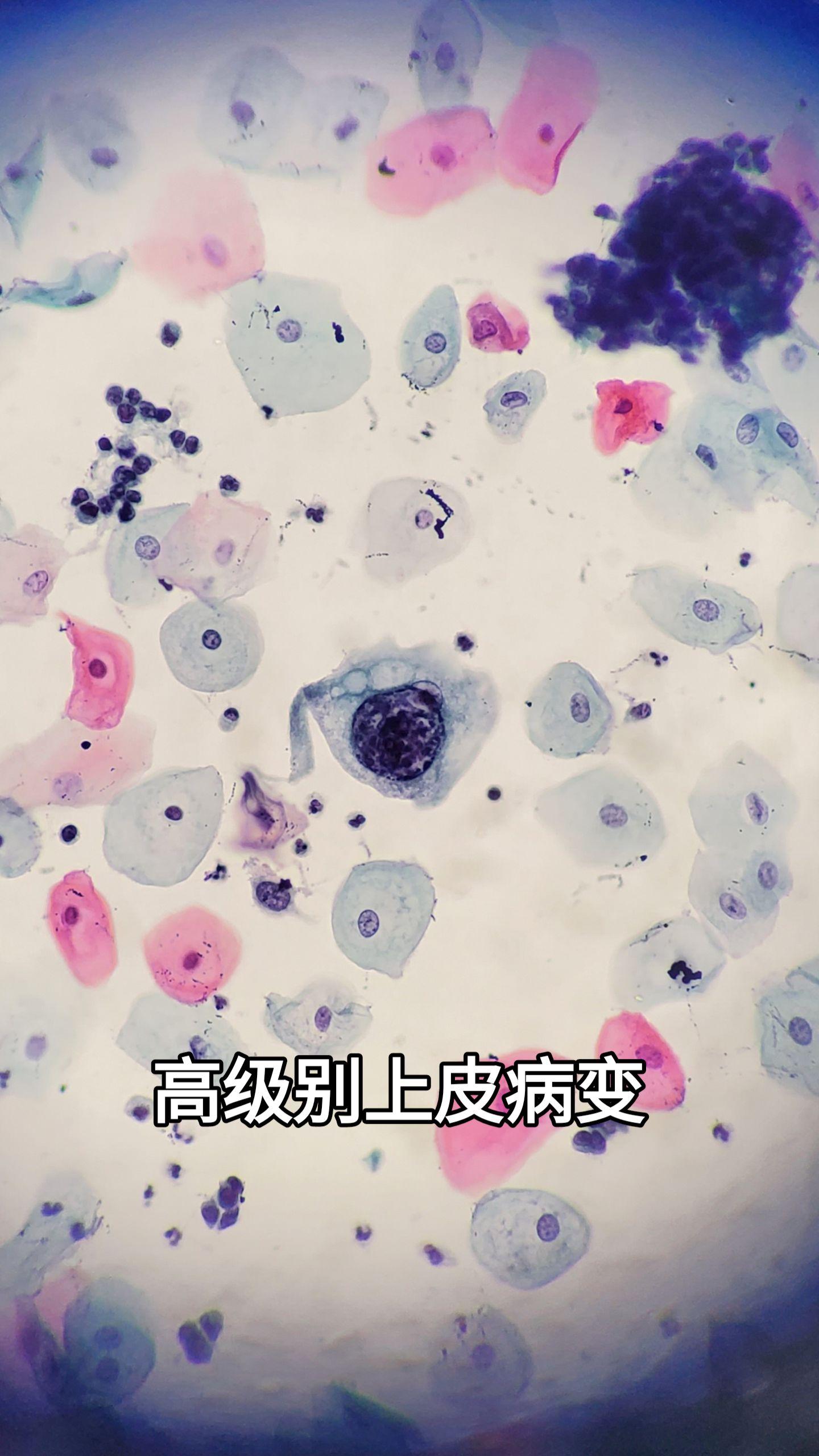 患者后续子宫切除，CIN3级累级腺体