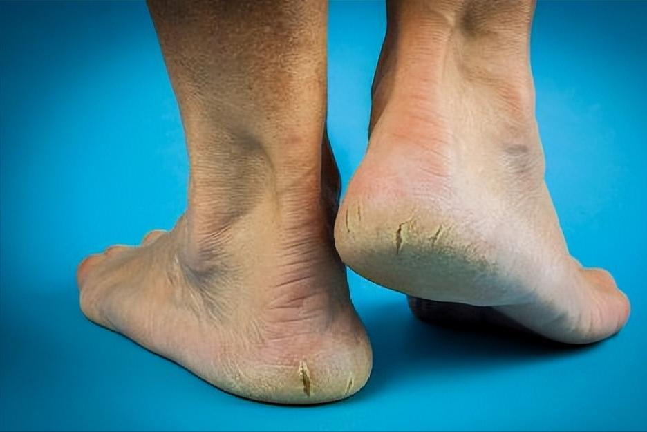 肾衰竭，脚先知？医生提醒：脚部出现这3种状况，一定要及时就医

肾脏出问题，身体