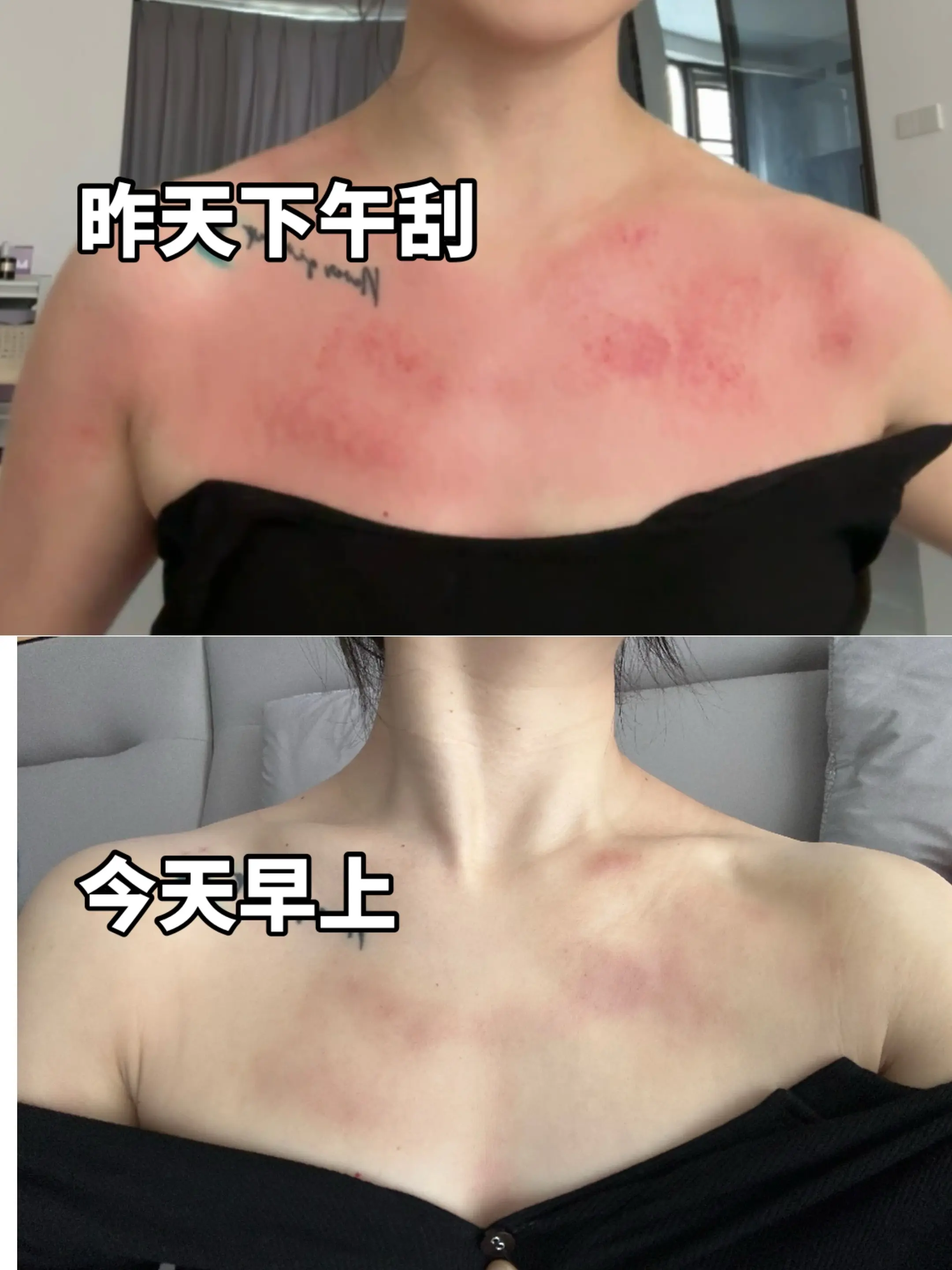 刮痧出痧不是目的。