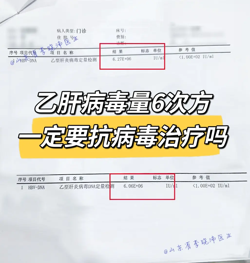 乙肝病毒量高到6次方 ！这是我上午的一个病号的单子，6次方的病毒量，说...