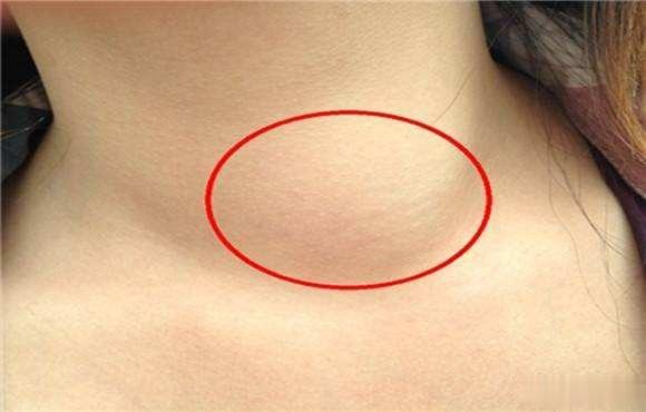 【得了甲状腺结节，碘盐是多吃还是少吃？】很多人搞不清甲状腺结节和碘之间的关系。其