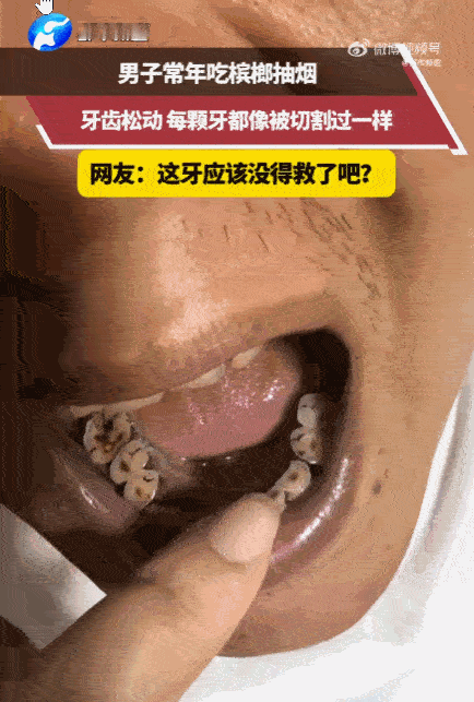 太恶心了！湖南，一男子一张嘴满口黑牙竟被齐刷刷“腰斩”，牙根都快磨没了，多颗牙一
