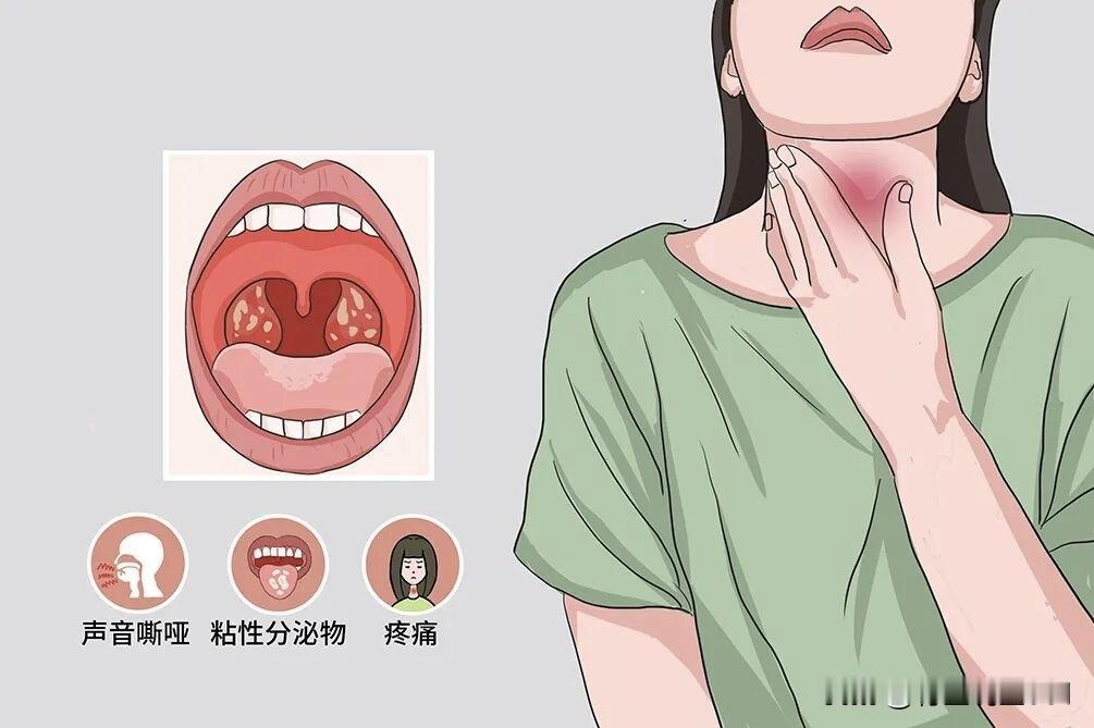 反复咽干咽痛？5个经典中成药调理慢性咽炎，温和护嗓不刺激，一文读懂
 
慢性咽炎