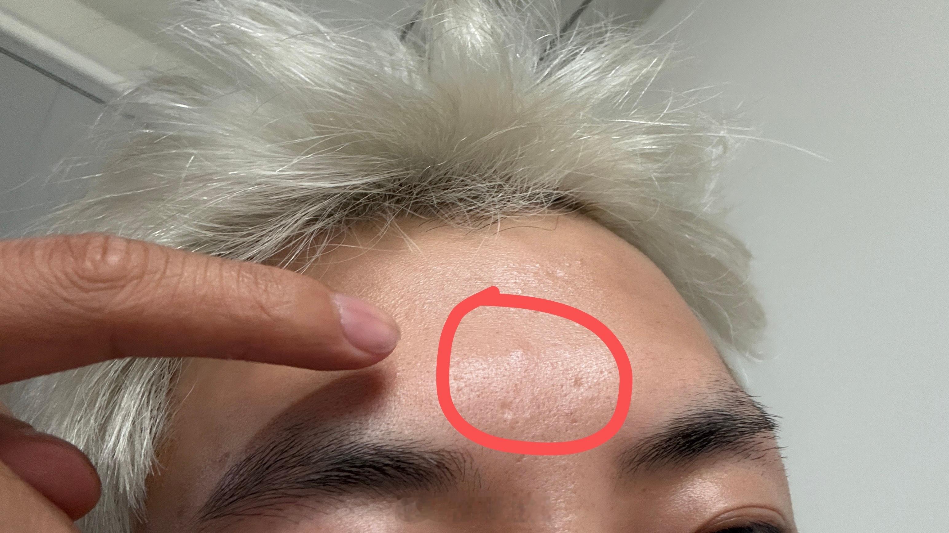 到底咋了，第四个火疖子。。。 