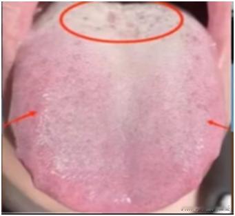 这种肾虚舌象调理的重点不在补肾，强调几百遍了，还是有人不听
患者主诉:那方面有心