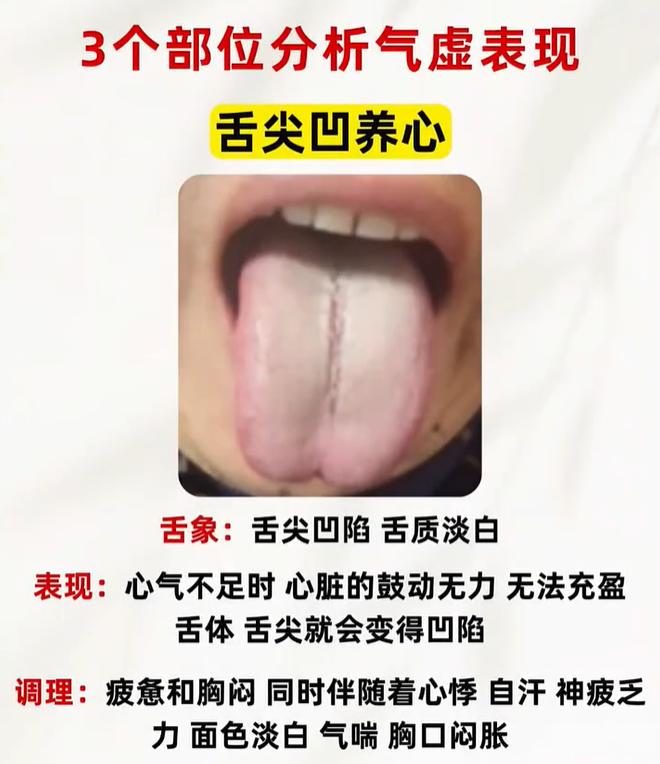 舌面三处凹陷辨证：心气、脾气、肾气不足舌象详解