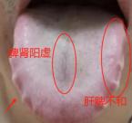 出现这种舌象，【活血】要考虑进去，别只知道疏肝补阳！
 
患者脾肾阳虚，寒湿已经