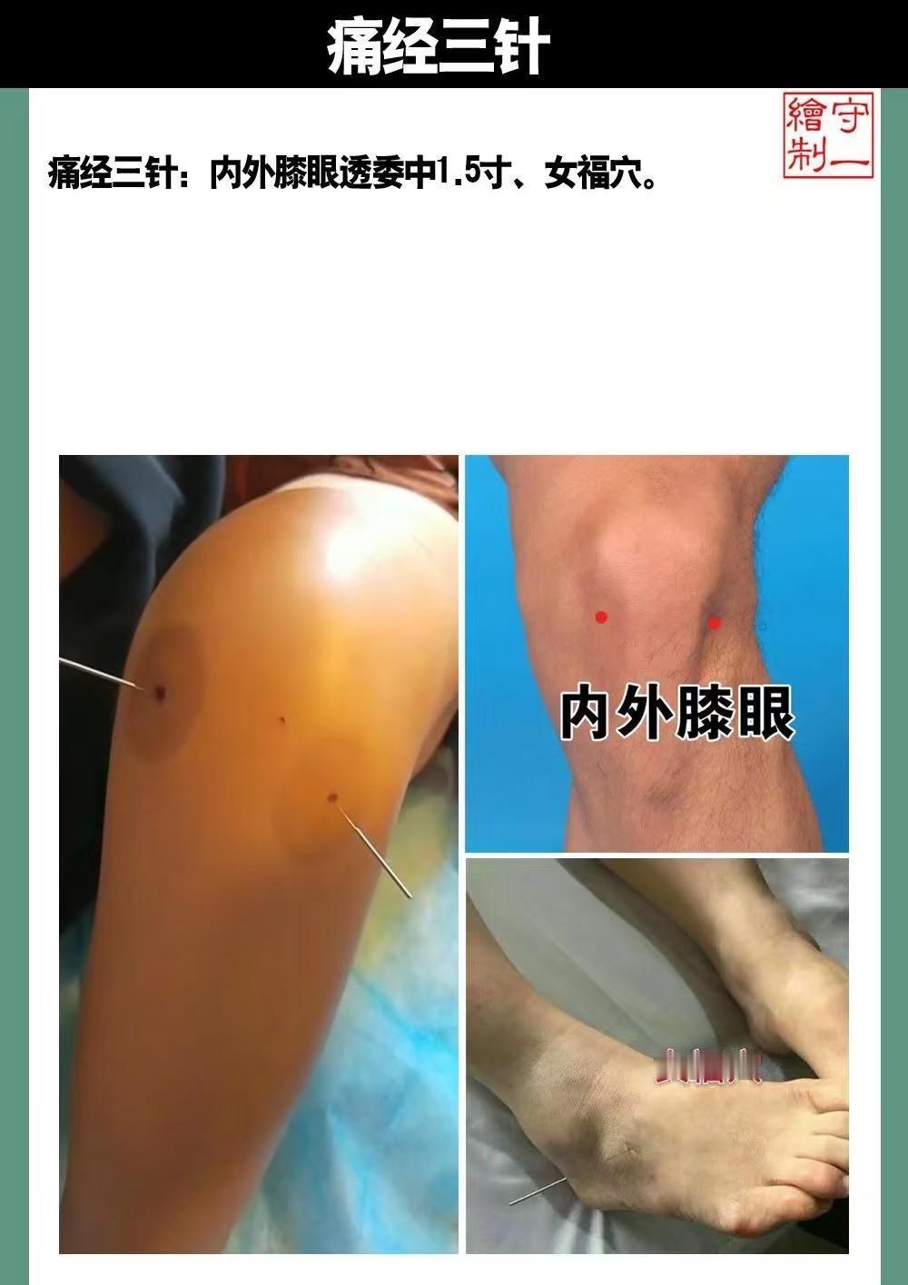针灸常见3针并用，共同改善7种常见病[给力][给力][给力]