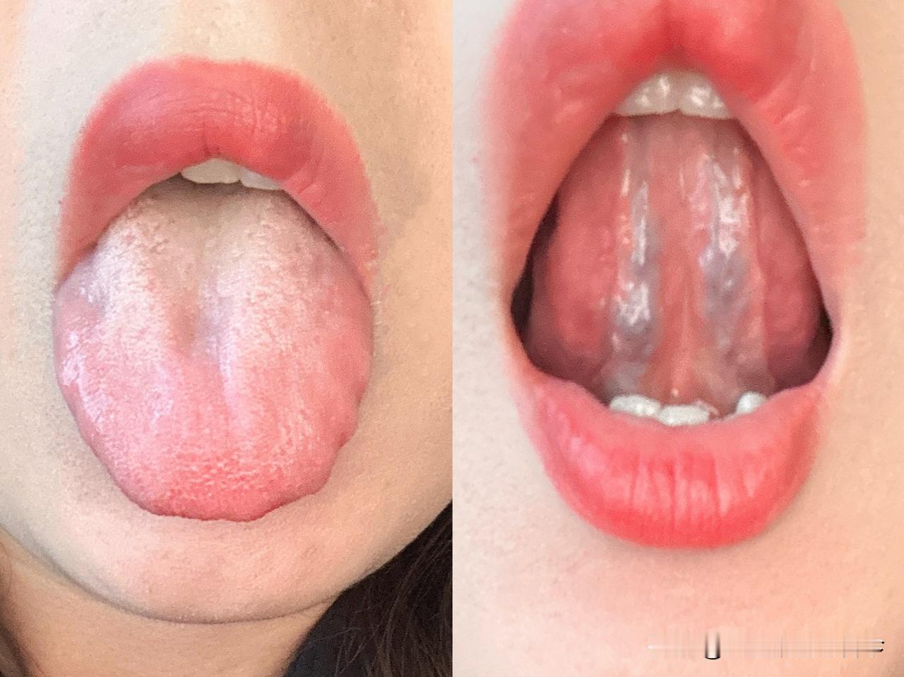 这种舌象，疏肝+健脾+补阳都兼顾到了，但还是没效？原因还在它身上！

患者主诉：