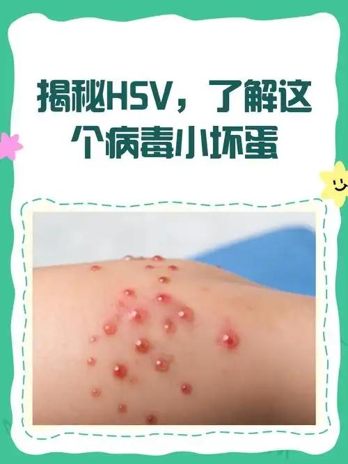 ‌HSV是单纯疱疹病毒‌（Herpes Simplex Virus）
是一种常见