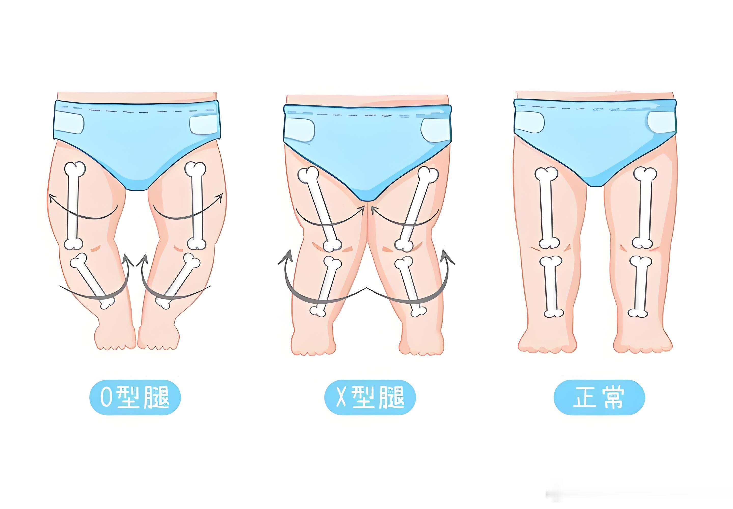 新手家长大多都有这种焦虑：宝宝腿不直、有点弯，会不会是O型腿、X型腿？给家长吃颗