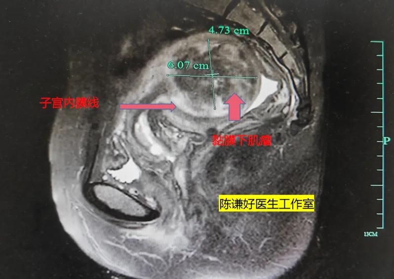 #子宫长肌瘤了,该怎么办呢?#子宫肌瘤是女性最常见的妇科良性肿瘤，大多数子宫肌瘤