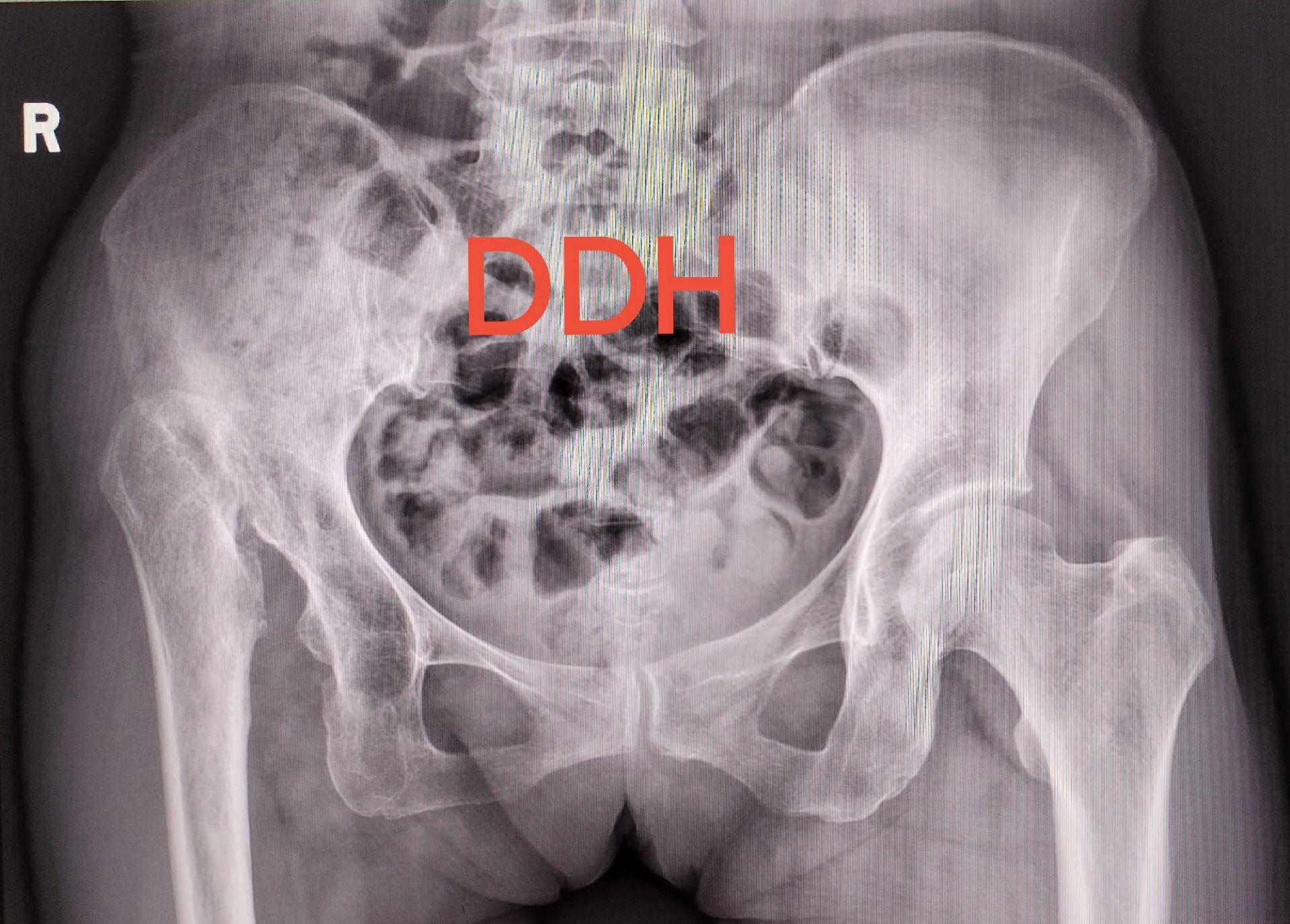 髋关节置换。DDH（先天性髋关节发育不良）四型高脱，要乐观，相信目前的技术，要有信心🌹
