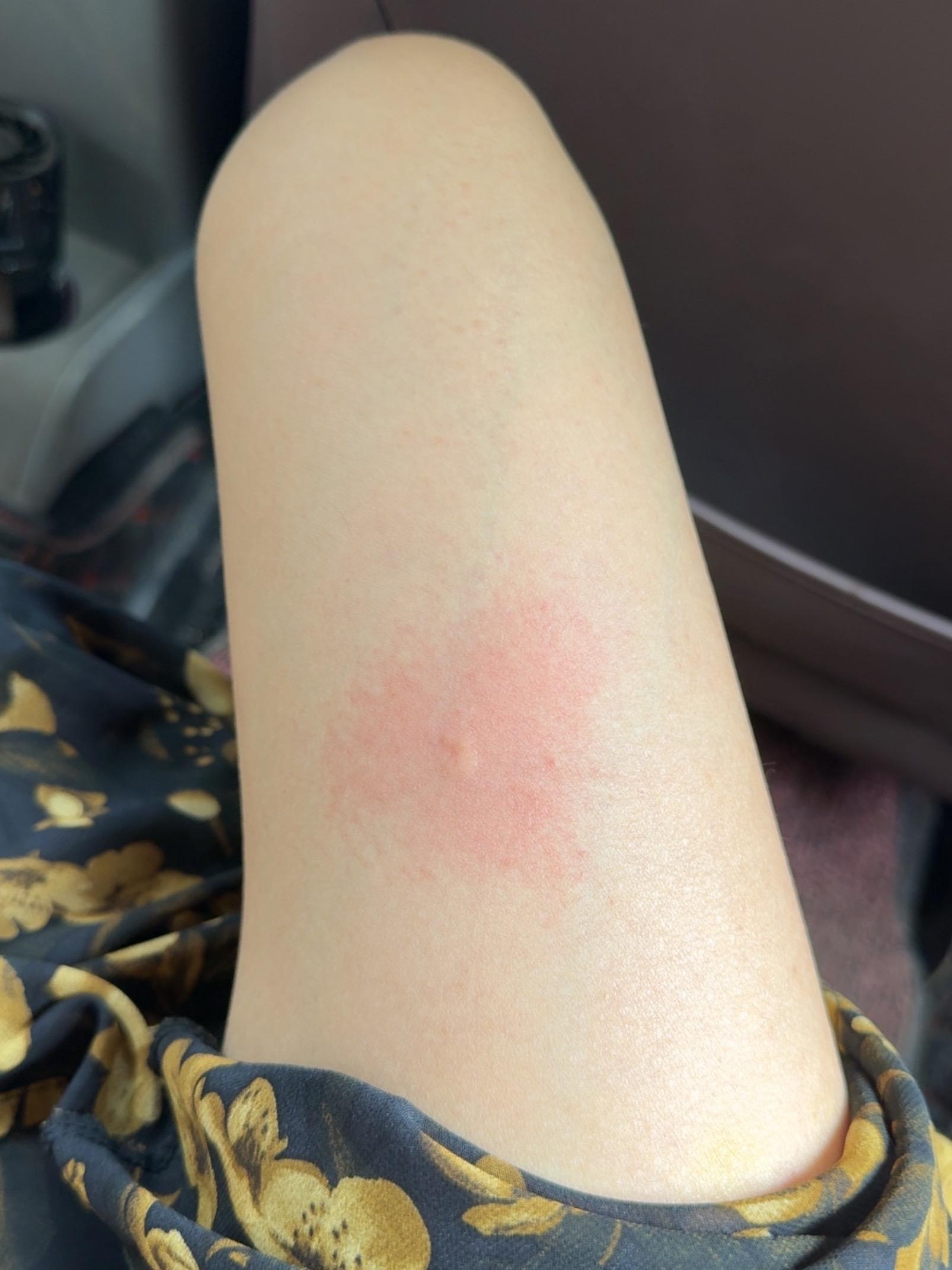蚊子，我恨你