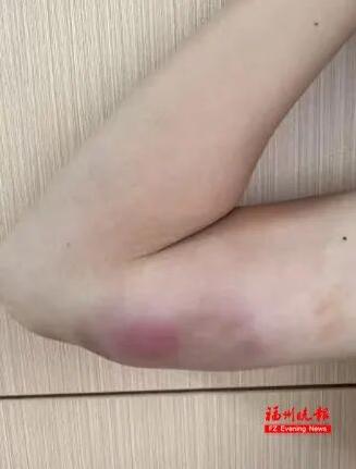 “这下后悔了吧！”近日，福建福州，一13岁男孩经常投喂流浪猫，结果手臂上长出一颗