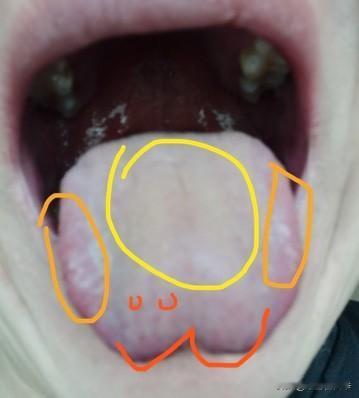 舌诊实战分享：
病人主诉：入睡难、乏力、口臭；
舌象分析：
心气不足：舌边部凹陷