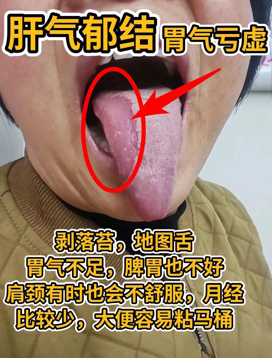 昨日舌象大PK 挑选三种舌象解读 看看你是哪种