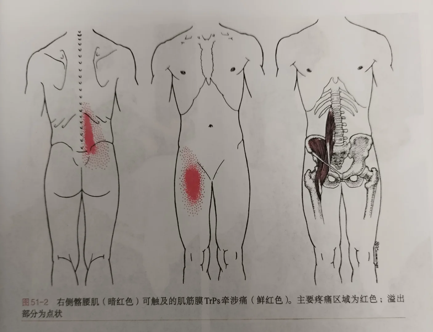 髂腰肌触发点表现