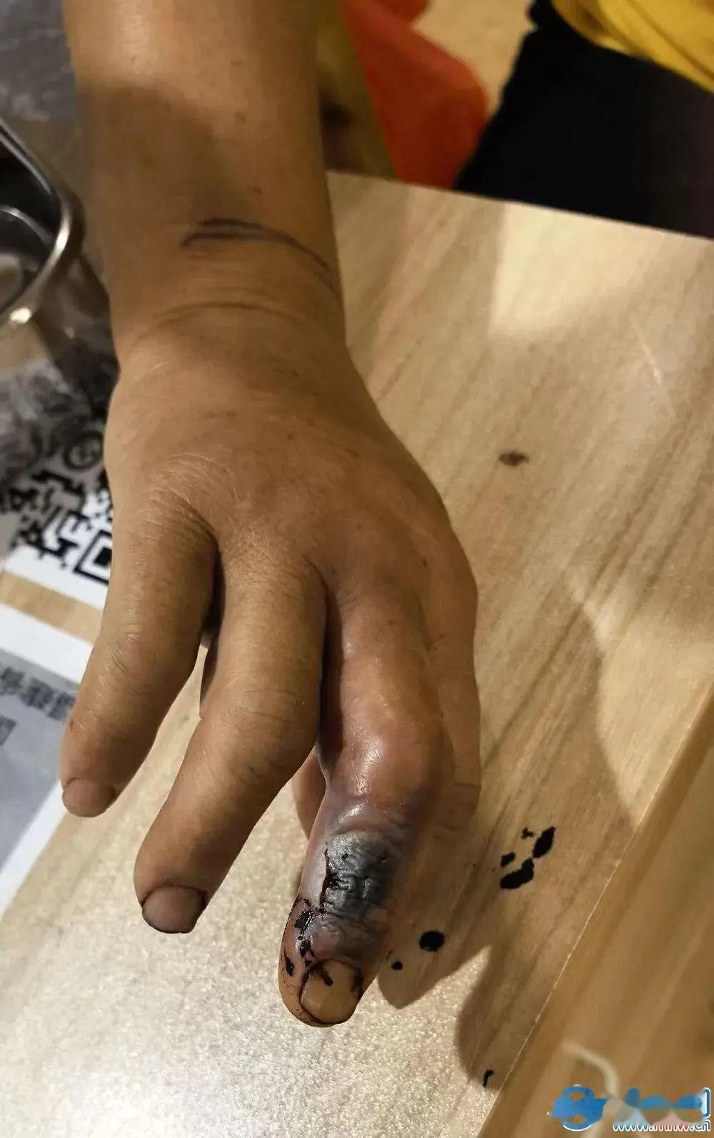被2米眼镜蛇当场咬伤，53岁阿姨反手活捉送医，硬核操作救了自己一命
 
很多人遇
