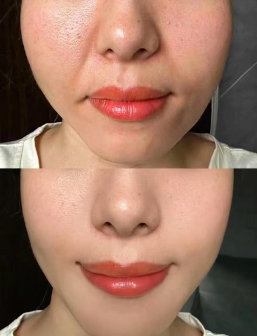 鼻子旁边沟就显老