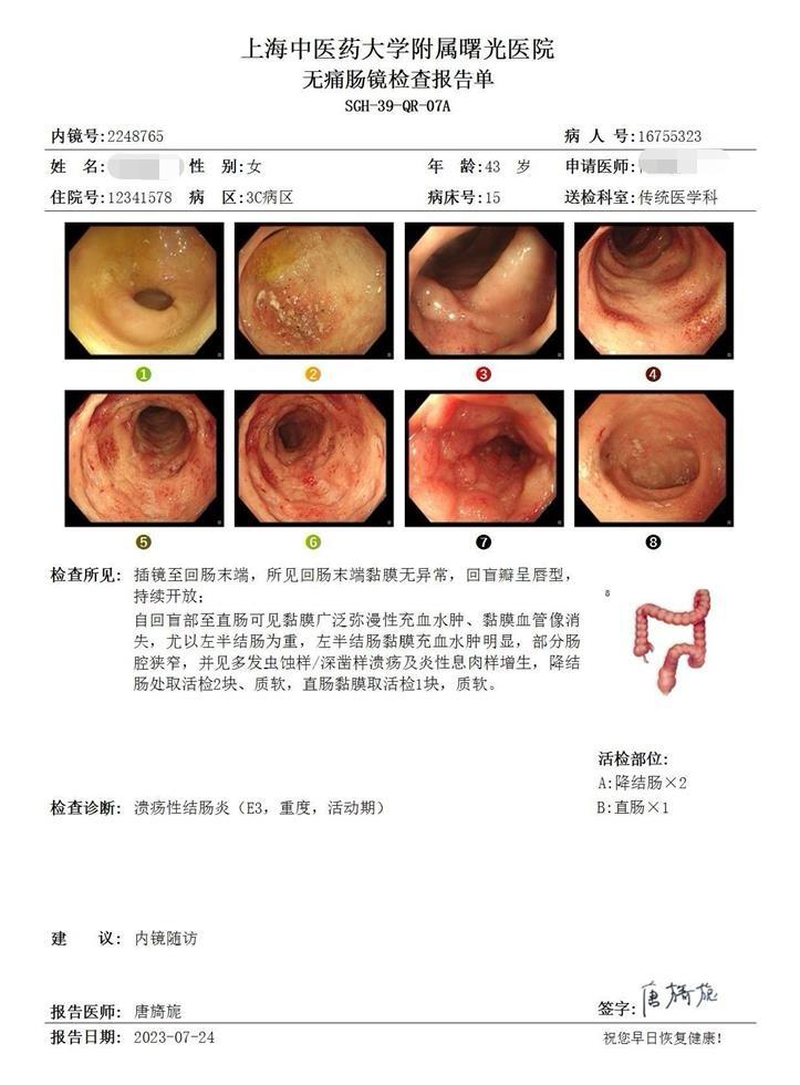 让重度全结肠激素依赖性溃结患者好转。患者10多年的病程，期间美沙拉嗪自...