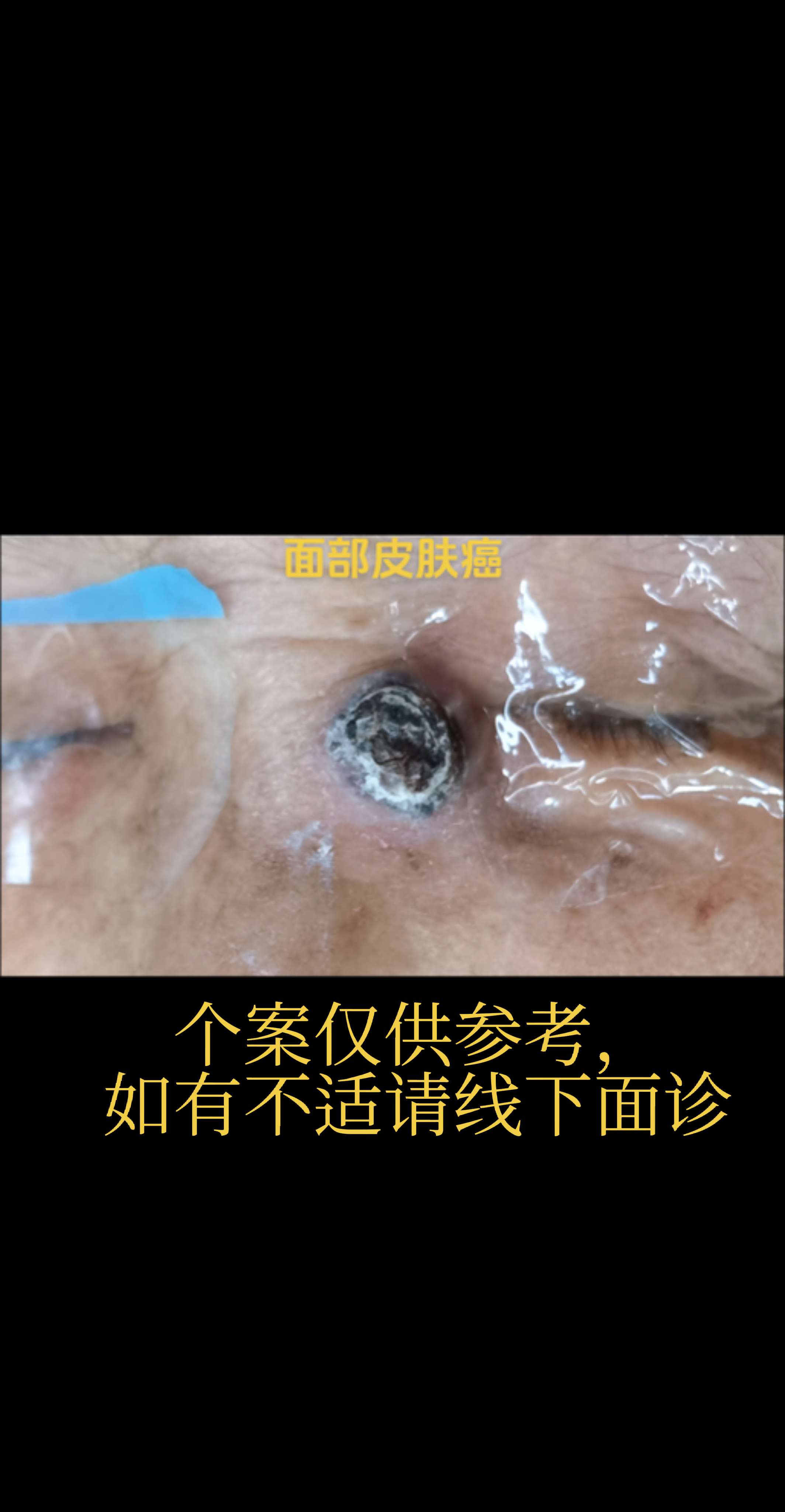 面部皮肤癌。左眼内眦处皮肤癌术前术后照片。