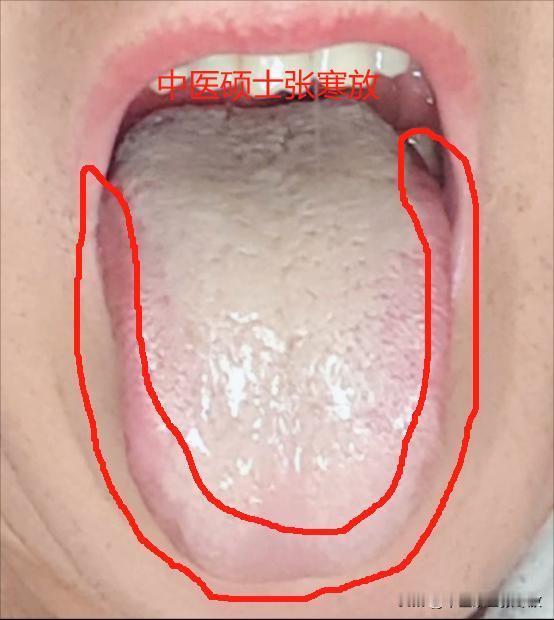 这样的舌头，阴囊潮湿、房事差，一个都逃不掉[抠鼻][抠鼻][抠鼻]
粉丝反馈：时