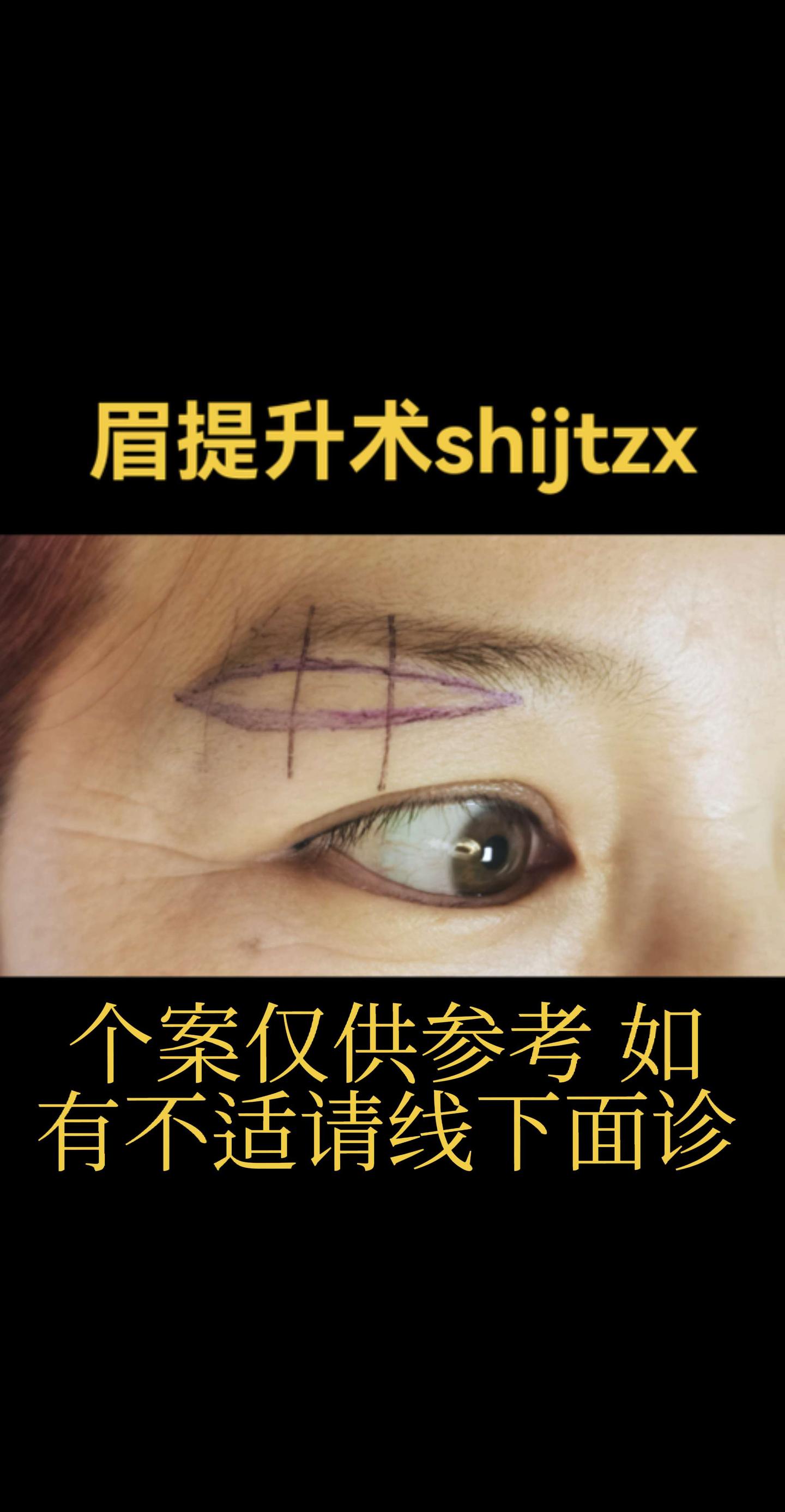 上睑皮肤松弛 眉提升术 医学科普