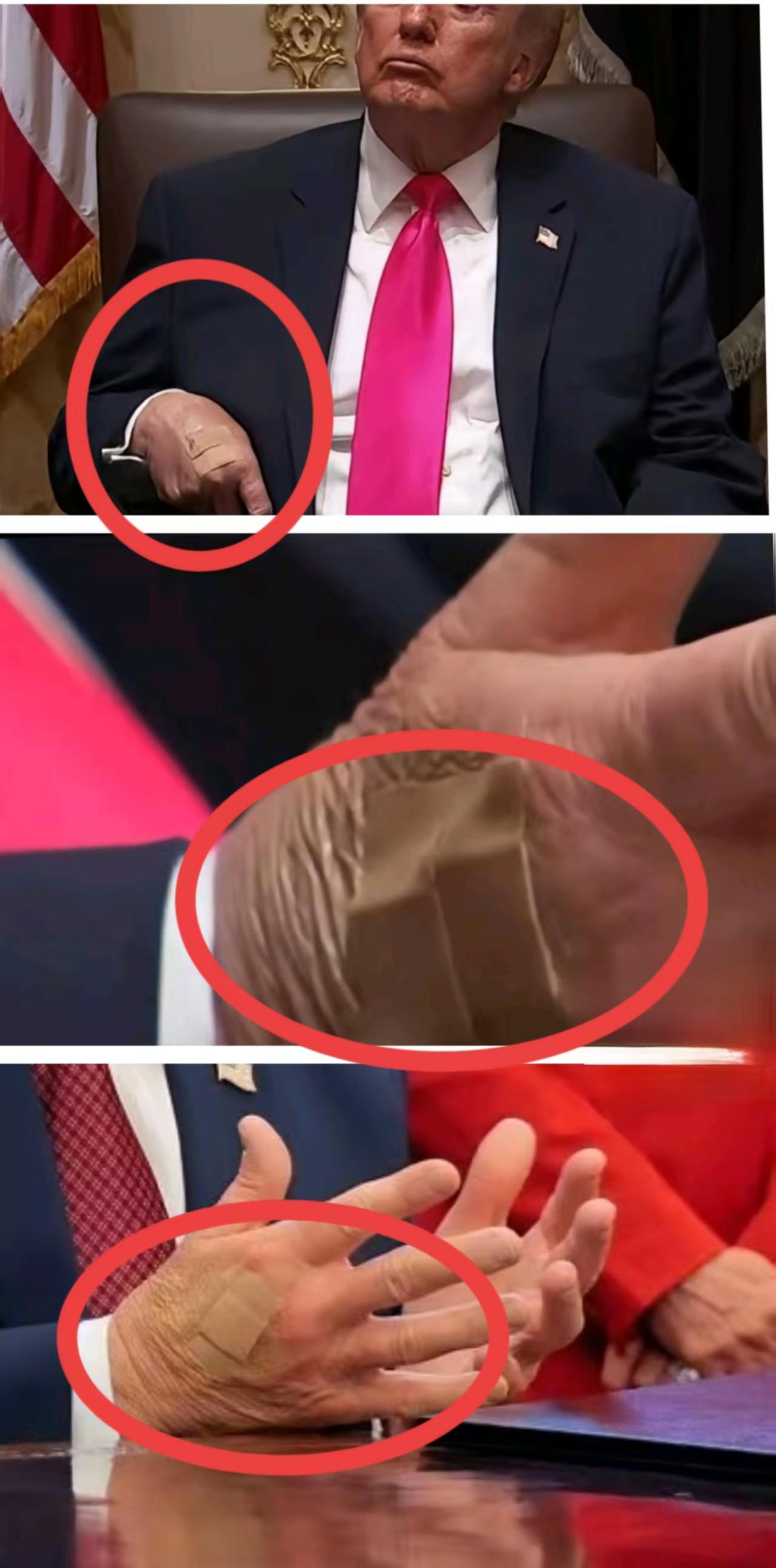 特朗普手上总带着伤，经常贴着创可贴，有时一块，有时两块，没人猜得透原因。

要是