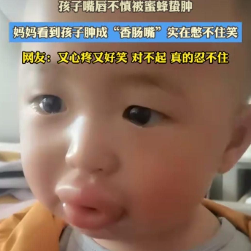 5月17日报道，贵州贵阳一名1岁多宝宝外出时，不慎被蜜蜂蛰到嘴巴，嘴唇迅速肿成了