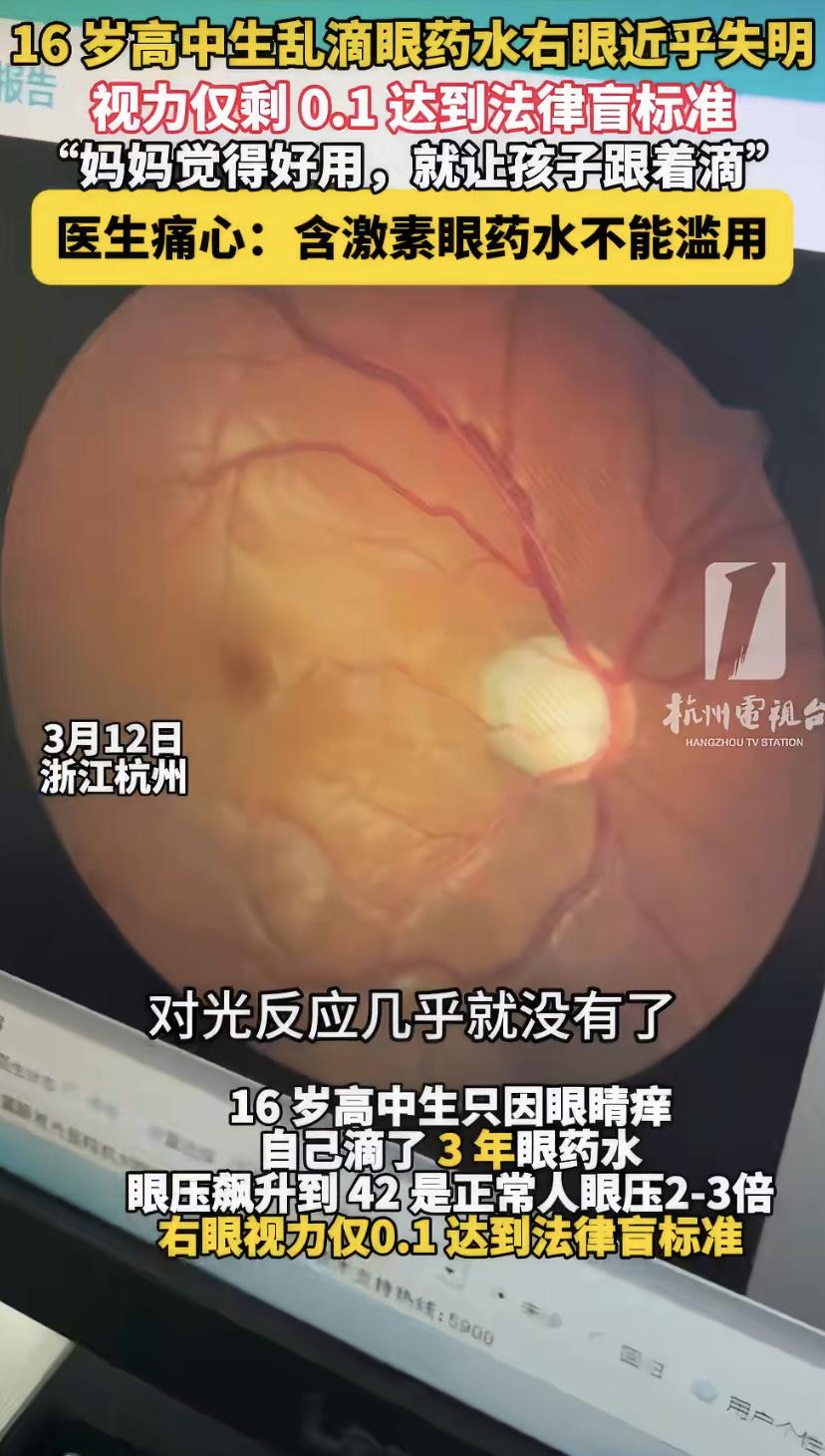 16岁男孩眼睛痒，妈妈好心用"神药"，三年后孩子右眼失明
浙江一位妈妈，怎么也没