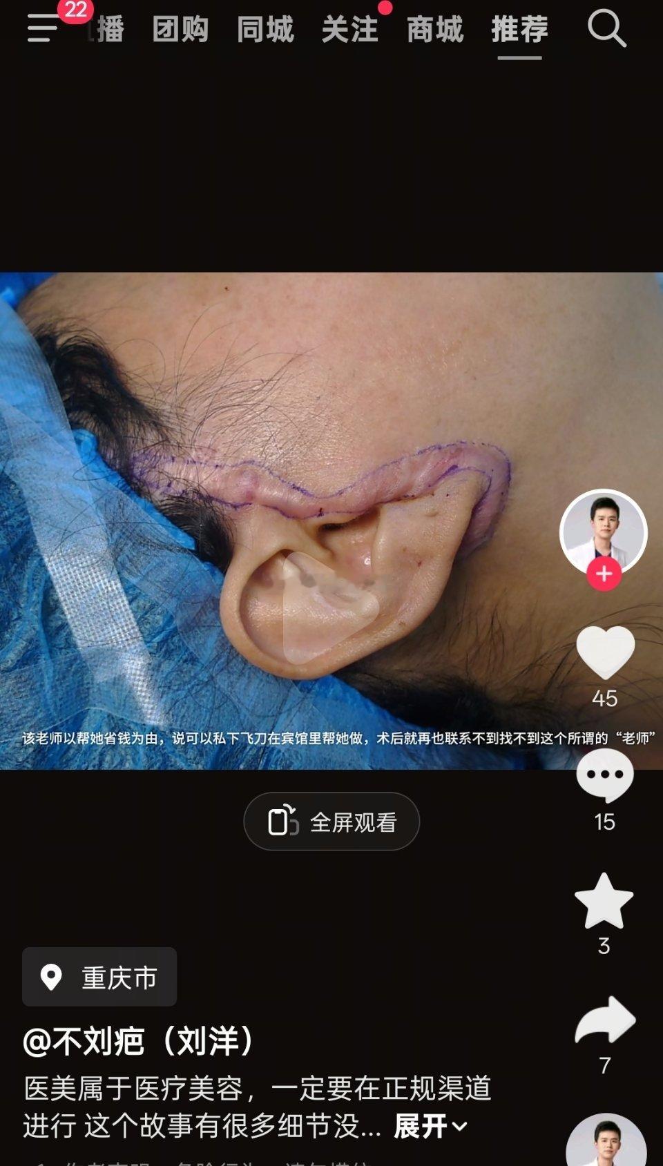 👑 拉皮一定是贵妇手术，是适合年纪大、面部松弛且费用昂贵的，非常挑解剖技术的手