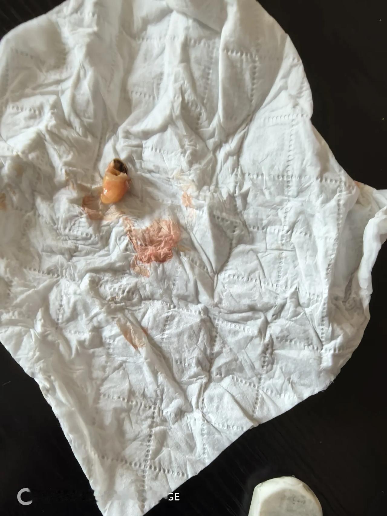 哎呀呀，可吓死我了。

今天周六，早早起来去把智齿拔了，牙掉完了，牙根是好的，也