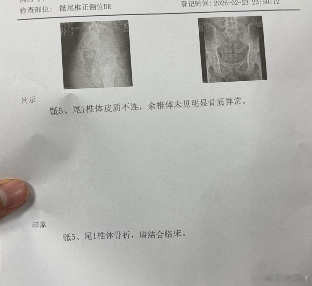 真的烦死了 尾椎骨折 