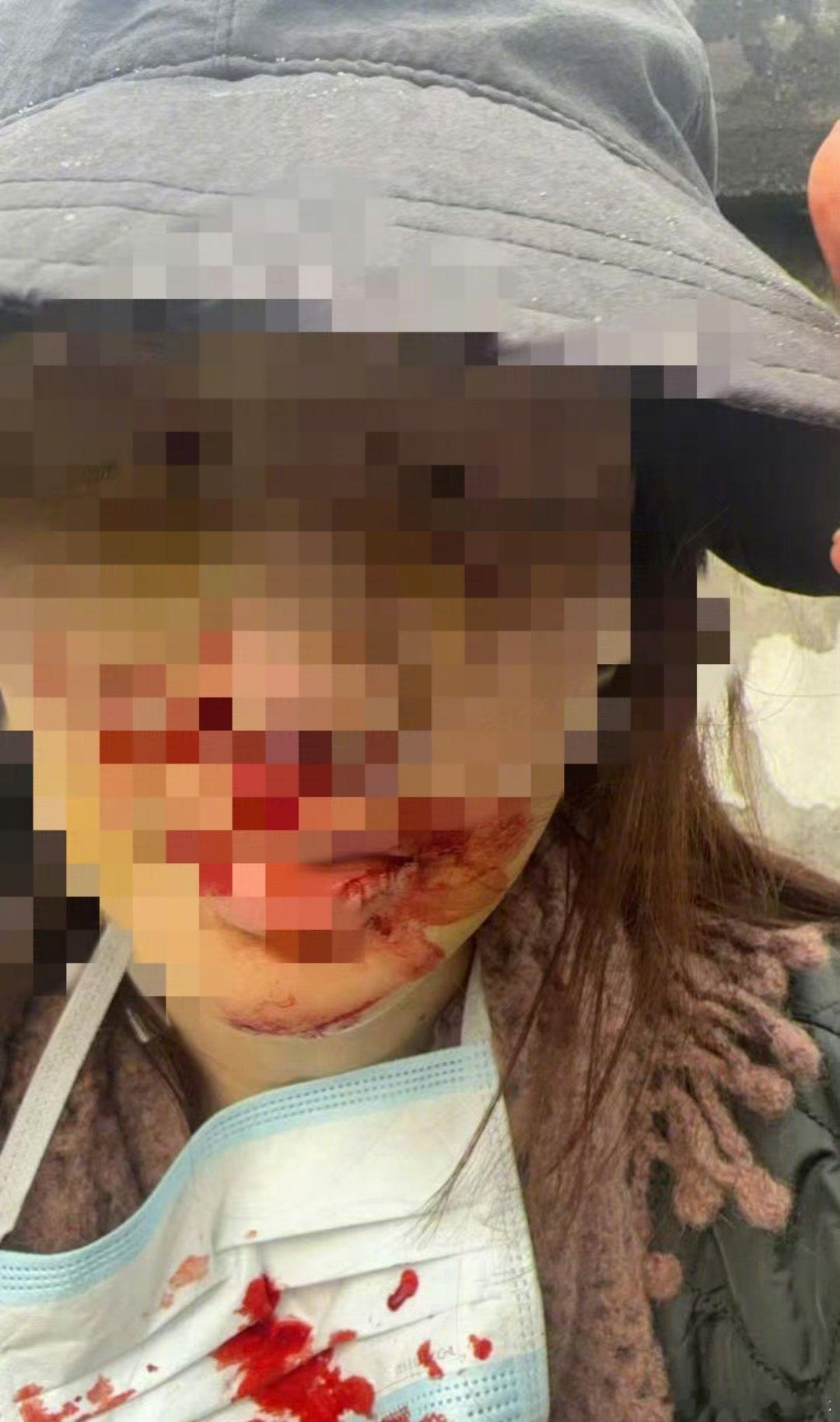 金晨回应肇事逃逸风波金晨道歉30日，发文道歉，表示事故发生后，“因我的伤势较重，