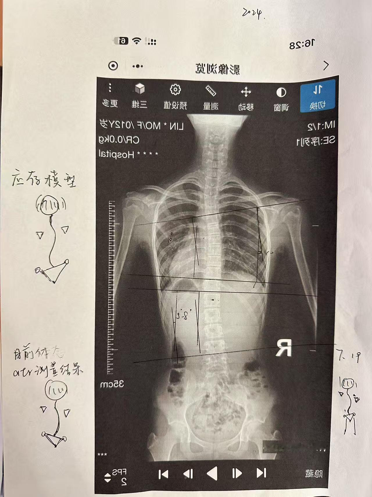脊柱侧弯还能回来吗 制定脊柱侧弯的康复方案，包含哪些步骤？看方向、量角度、画图分