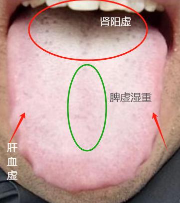 忙碌一年回到家，面对老婆“软趴趴”，一补还上火！
患者李先生，自述“举旗”无力，