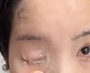 贵州贵阳的何女士用502胶水贴甲片时，胶水喷进眼睛、鼻子，眼皮粘死，眼球损伤。她